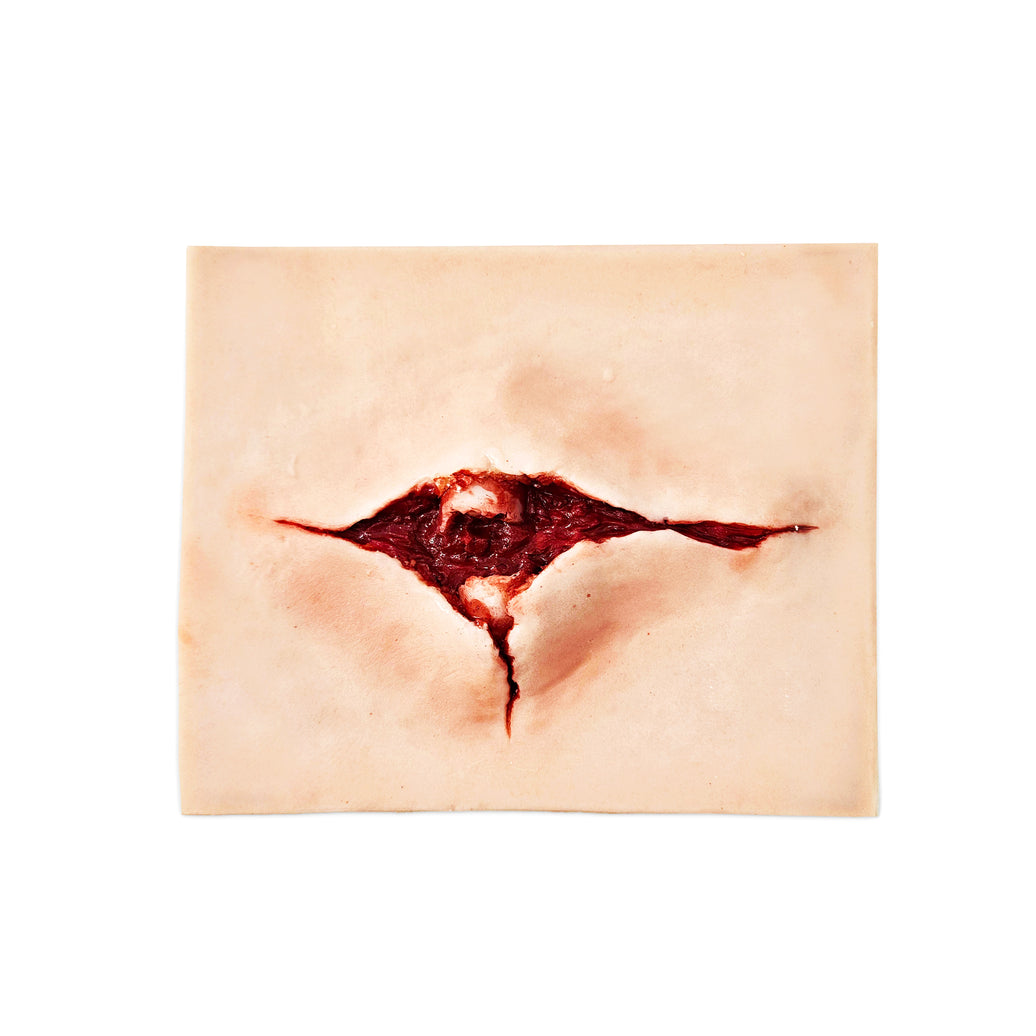 Open Fracture Trauma