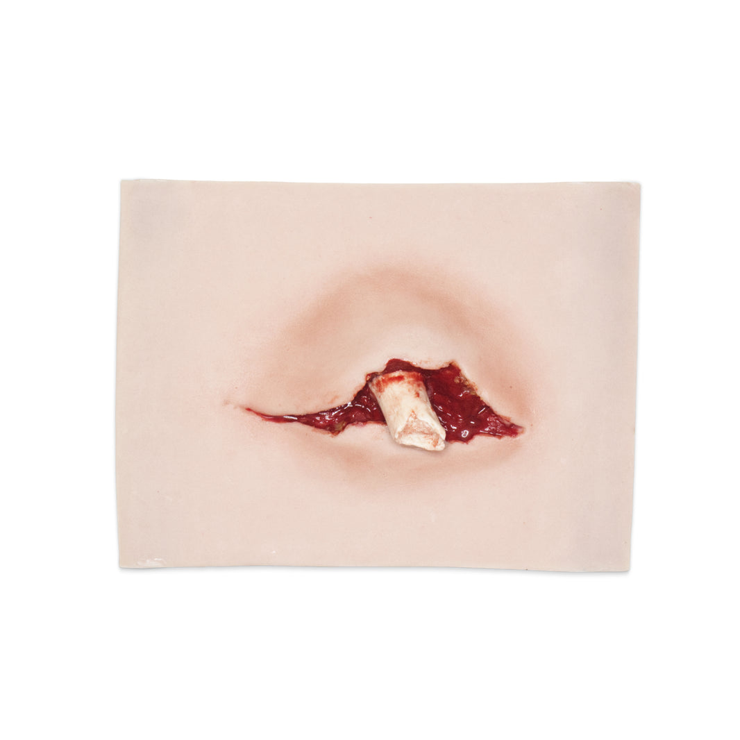 Protruding Femur Fracture