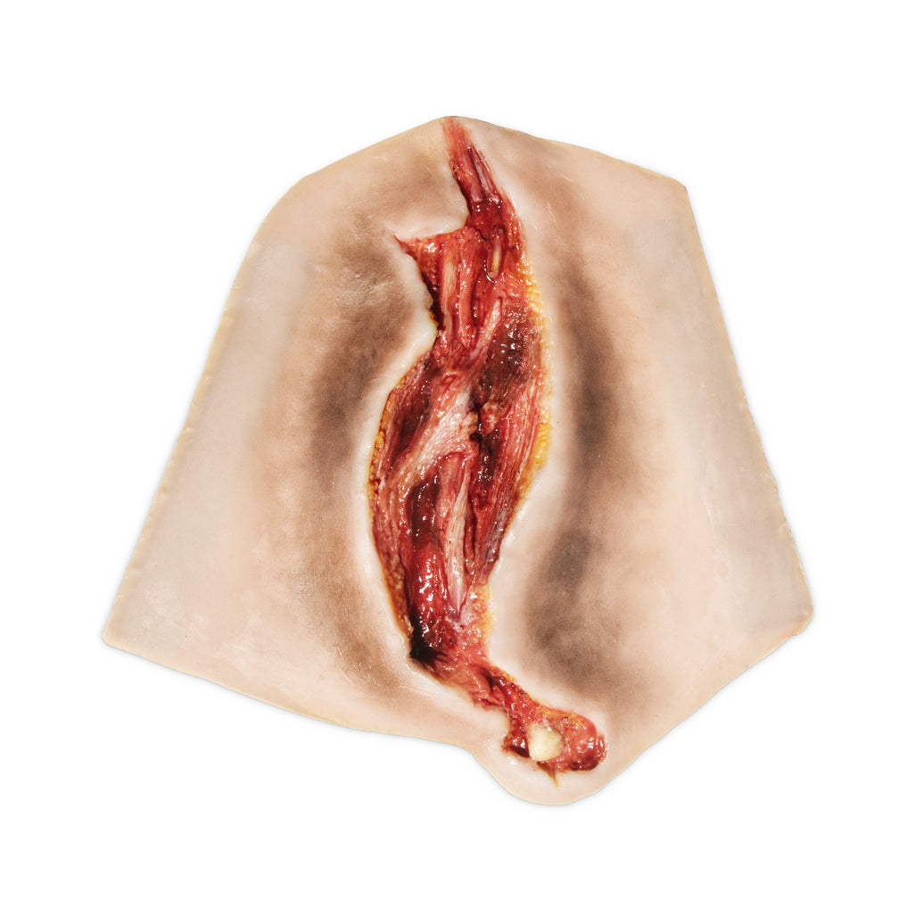 Electrical Burn Lower Arm