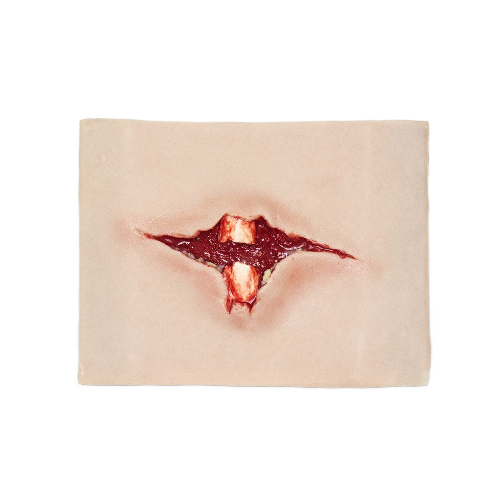 Open Fracture Trauma - Basic Version