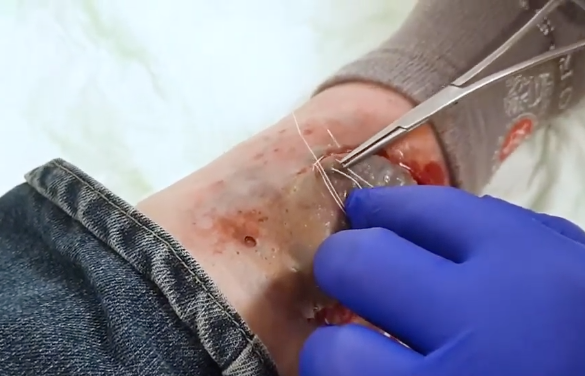 How to use MEDICFX Strap-on wounds