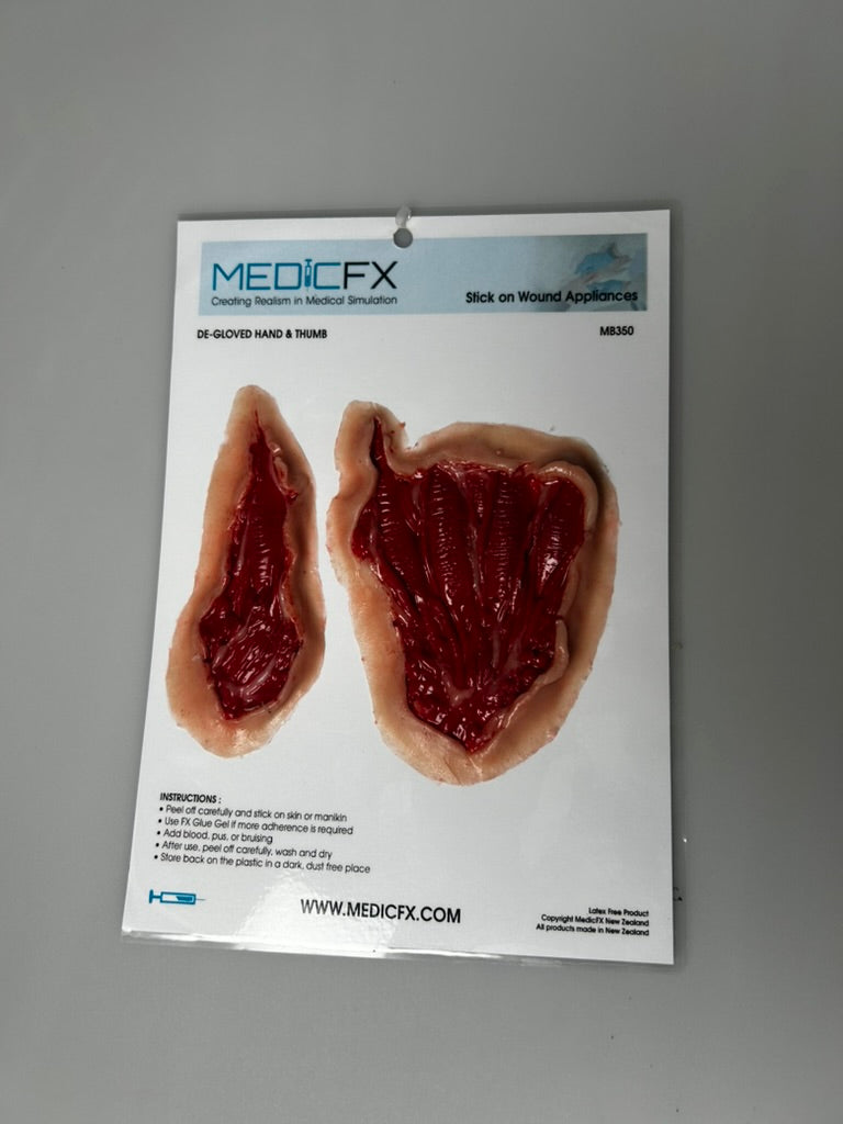 SALE- MB350 De-Gloved Hand &amp; Thumb