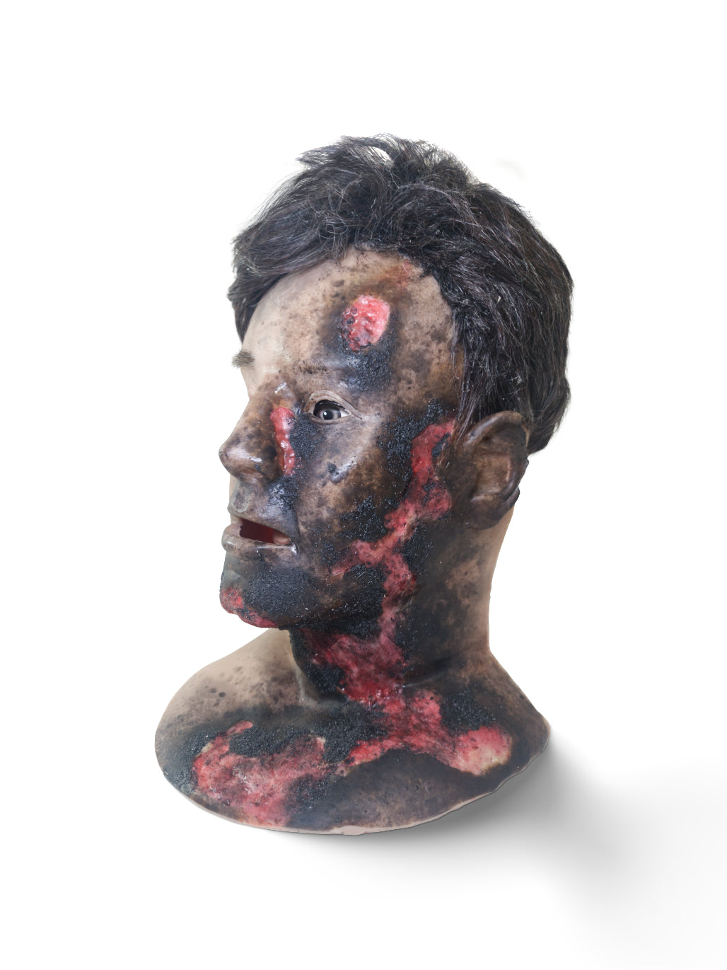 MB810 Burn Victim