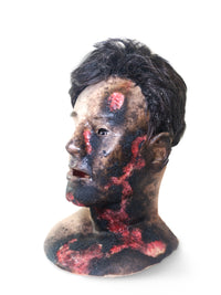 Burn Patient