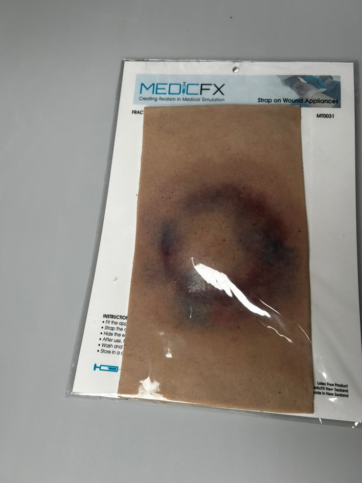 SALE- MT0031 Fracture closed small