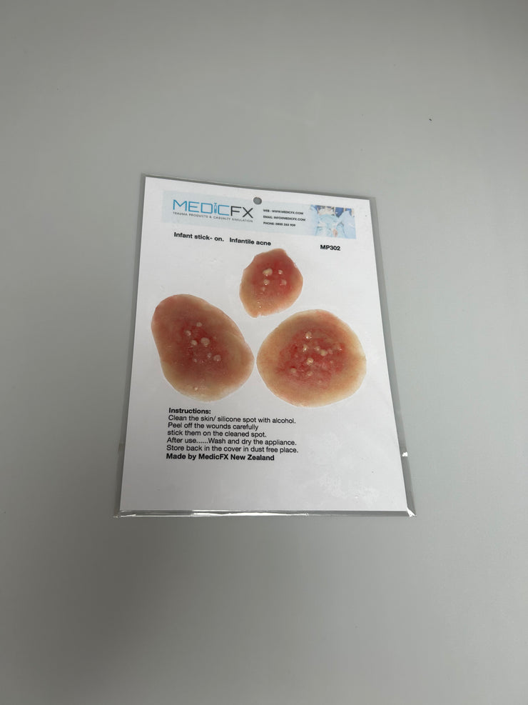 SALE- MP302 Infantile Acne