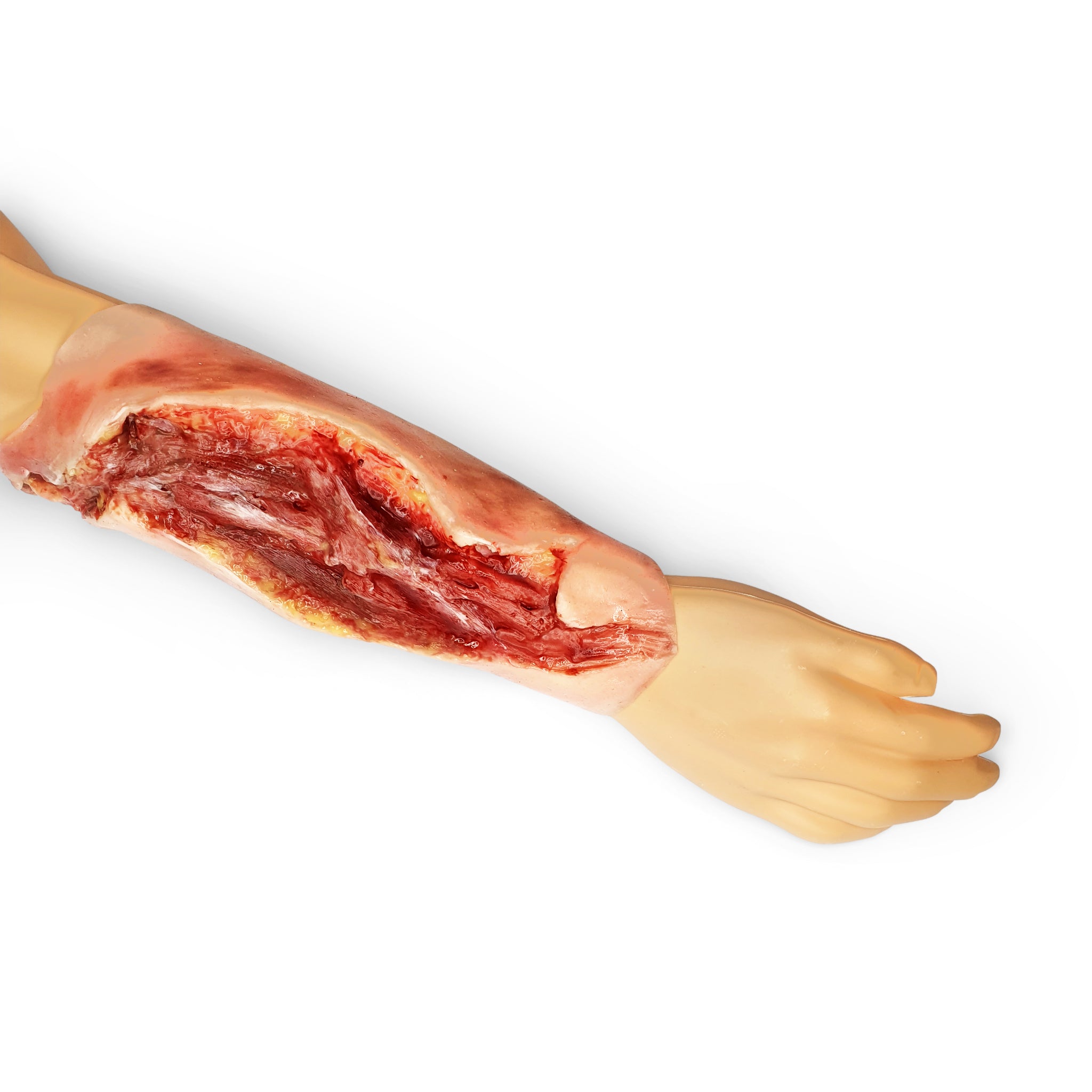 Electrical Burn Lower Arm