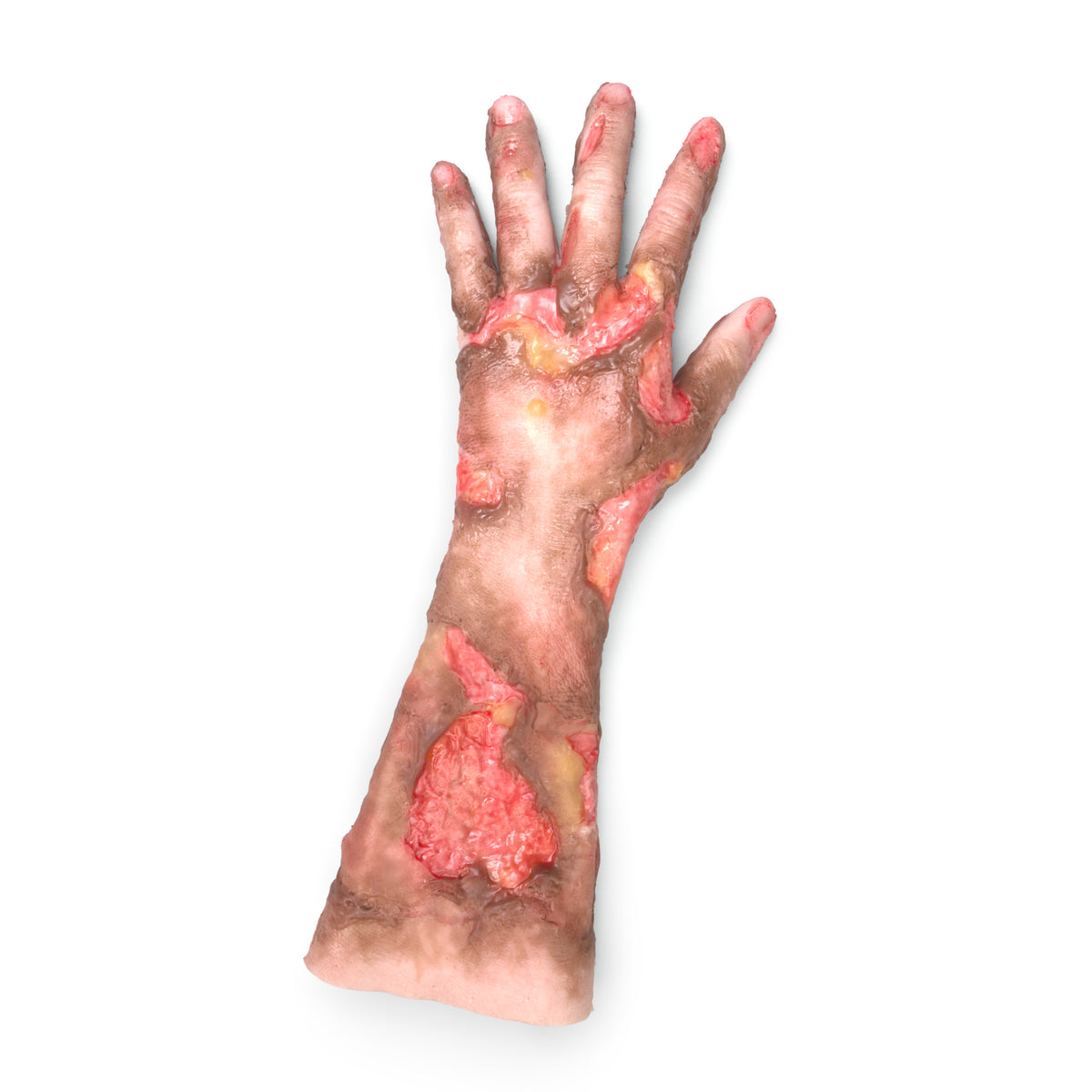 Burn Patient
