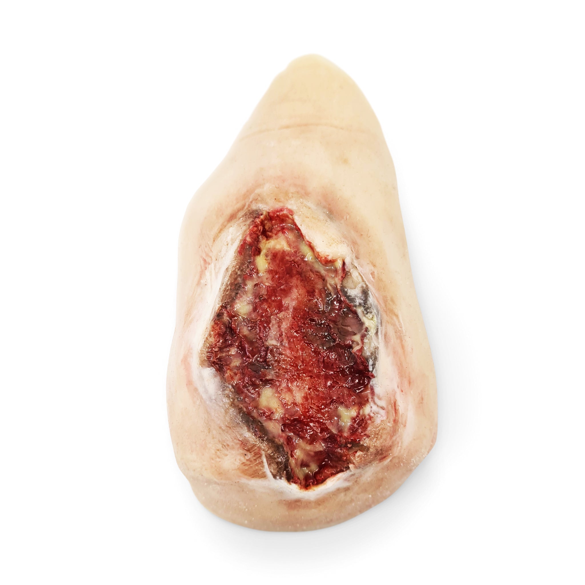 Electrical Burn Heel