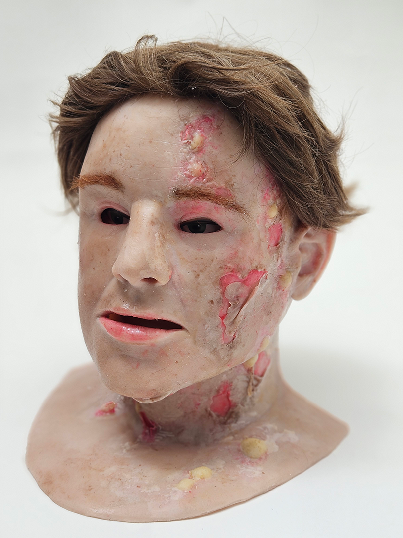 MB810 Burn Victim