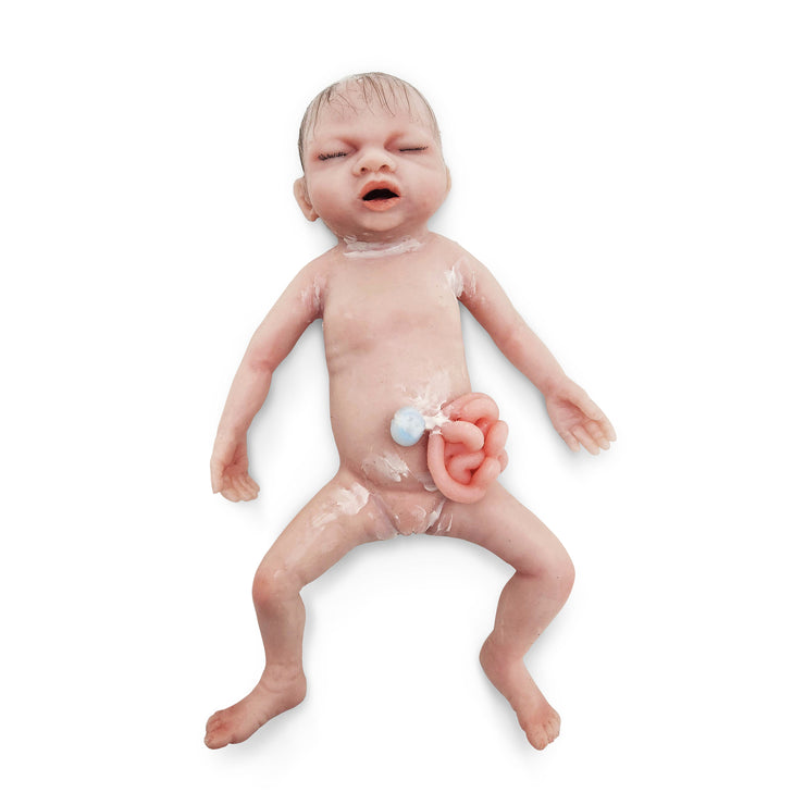 Baby Libby Gastrochisis