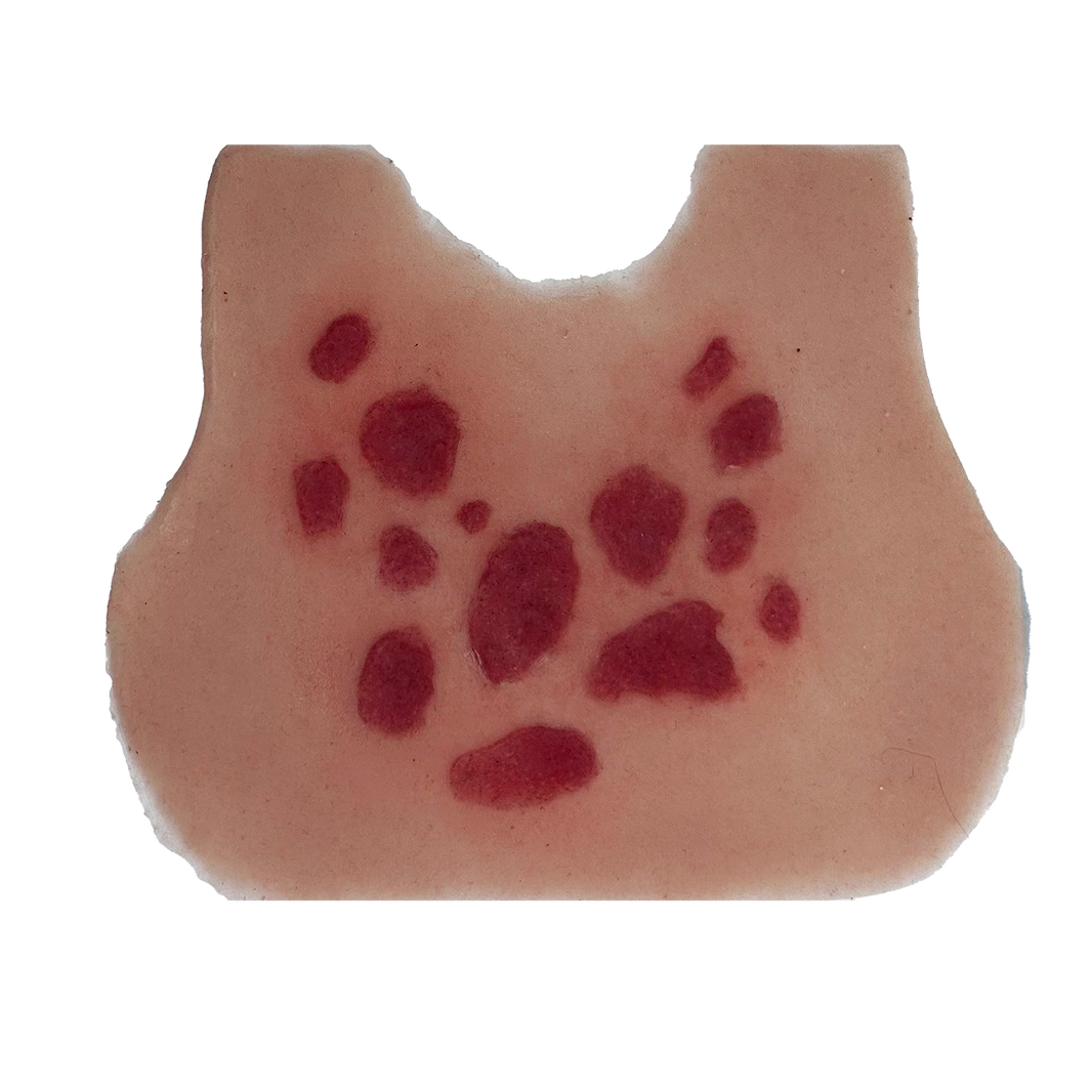 Anaphylactic Rash