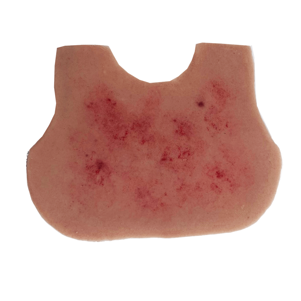 Meningitis Rash Infant Chest