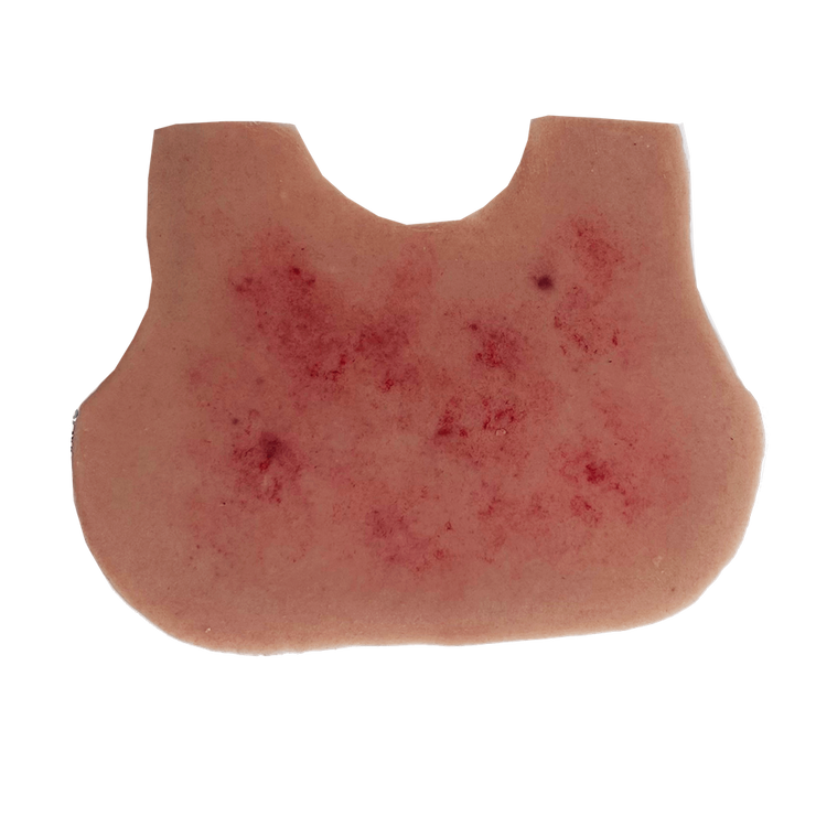 Meningitis Rash Infant Chest