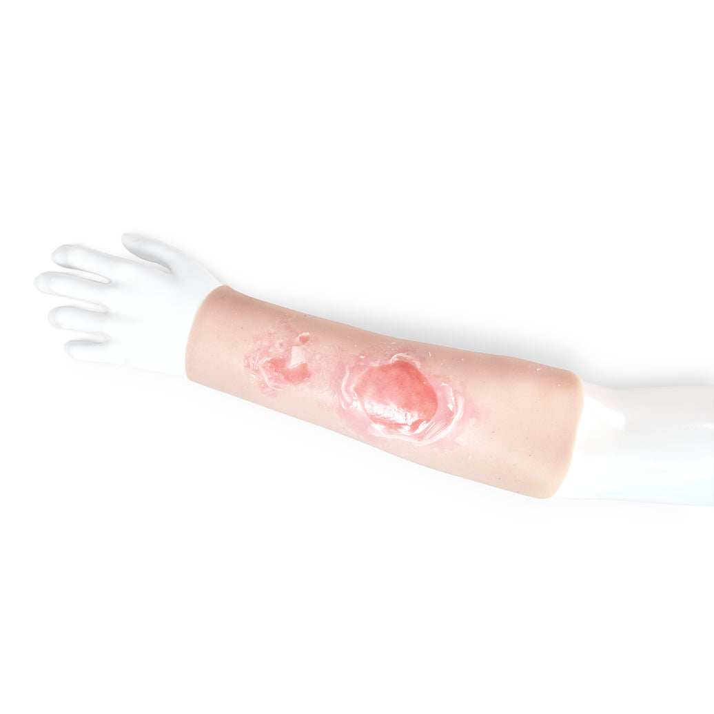 Scalding Burn Sleeve