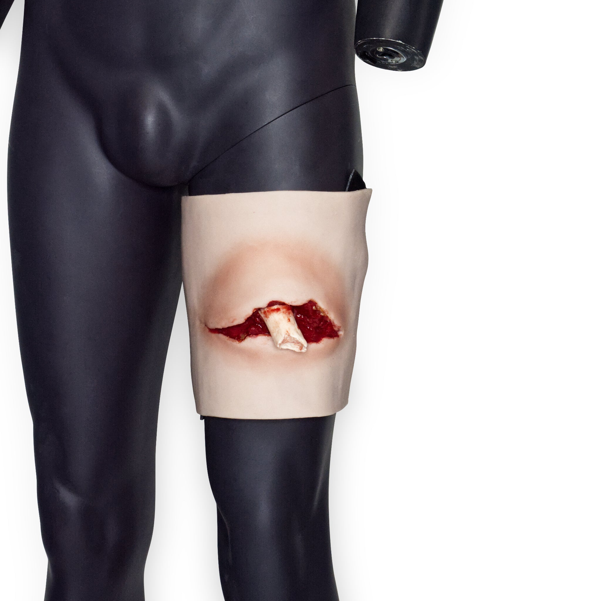 Protruding Femur Fracture