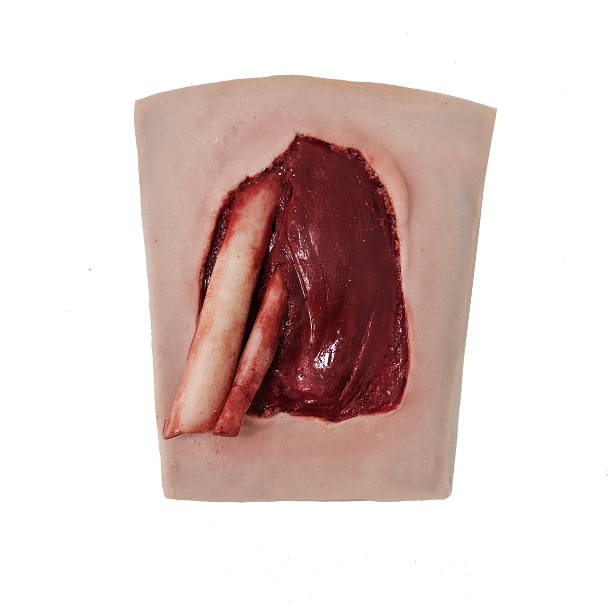Tib Fib Fracture