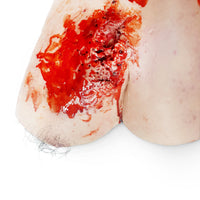 Trauma Wound Packing Shoulder