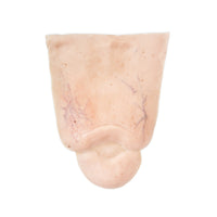 Edema Leg