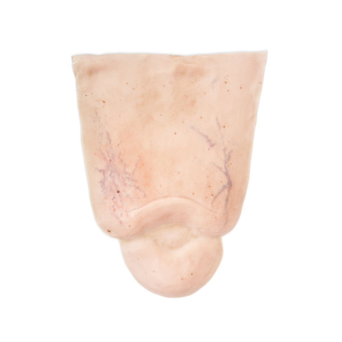 Edema Leg