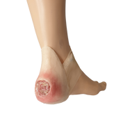 Bedsore On Heel