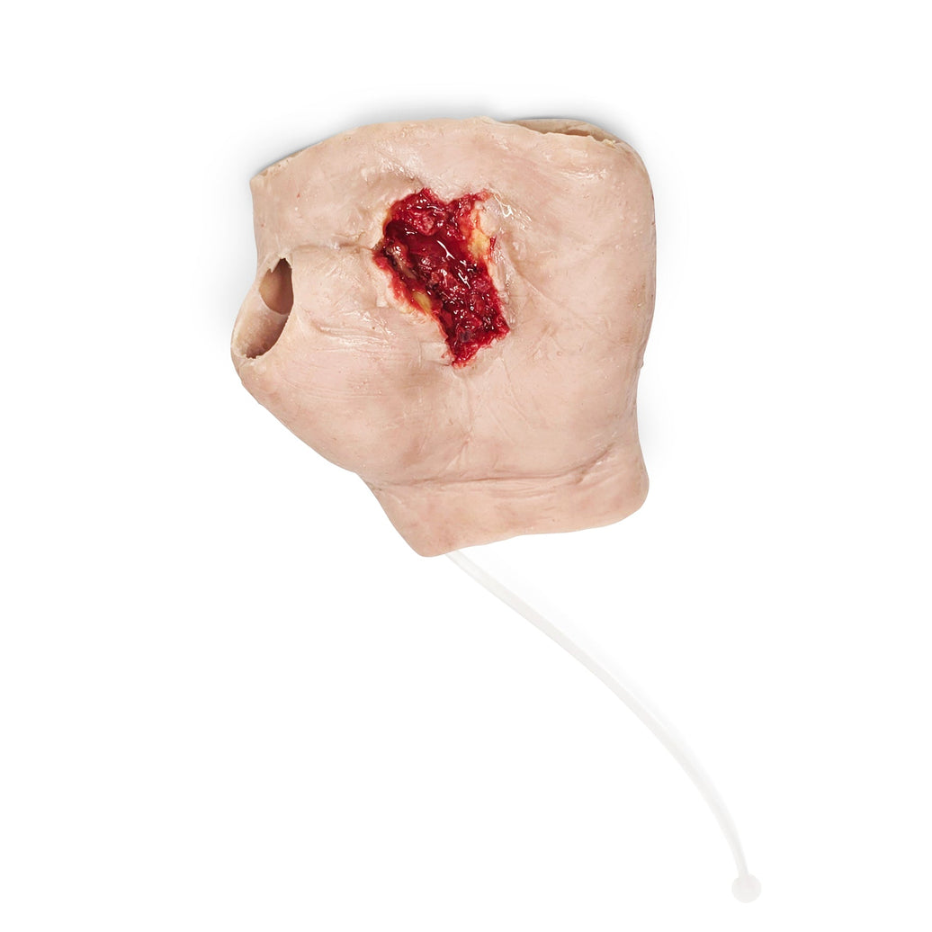 Perforating Left Hand Gun Shot Wound (New)