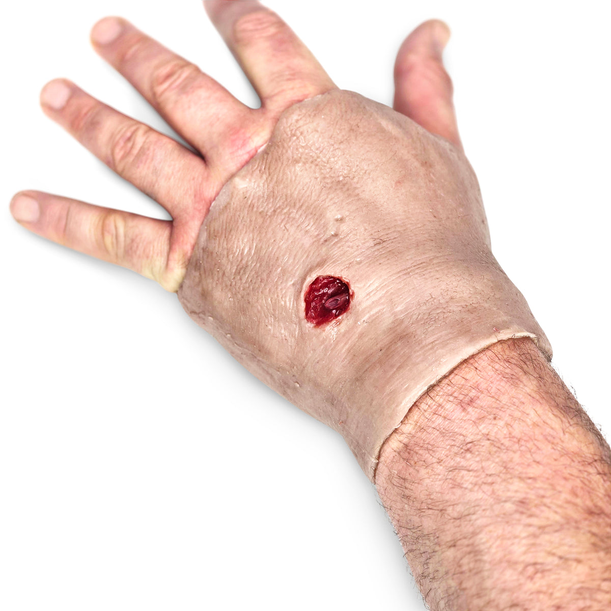 Perforating Left Hand Gun Shot Wound (New)