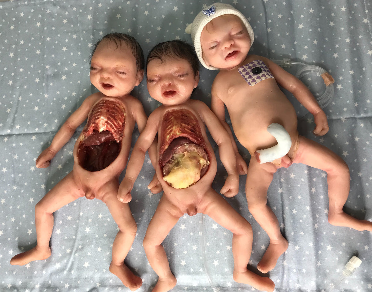 Preemie Patrick showing all 3 stages