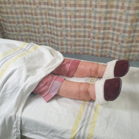 Edema Leg